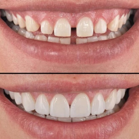 Виниры зубные Perfect Smile Veneers сменные White (kz059-hbr)