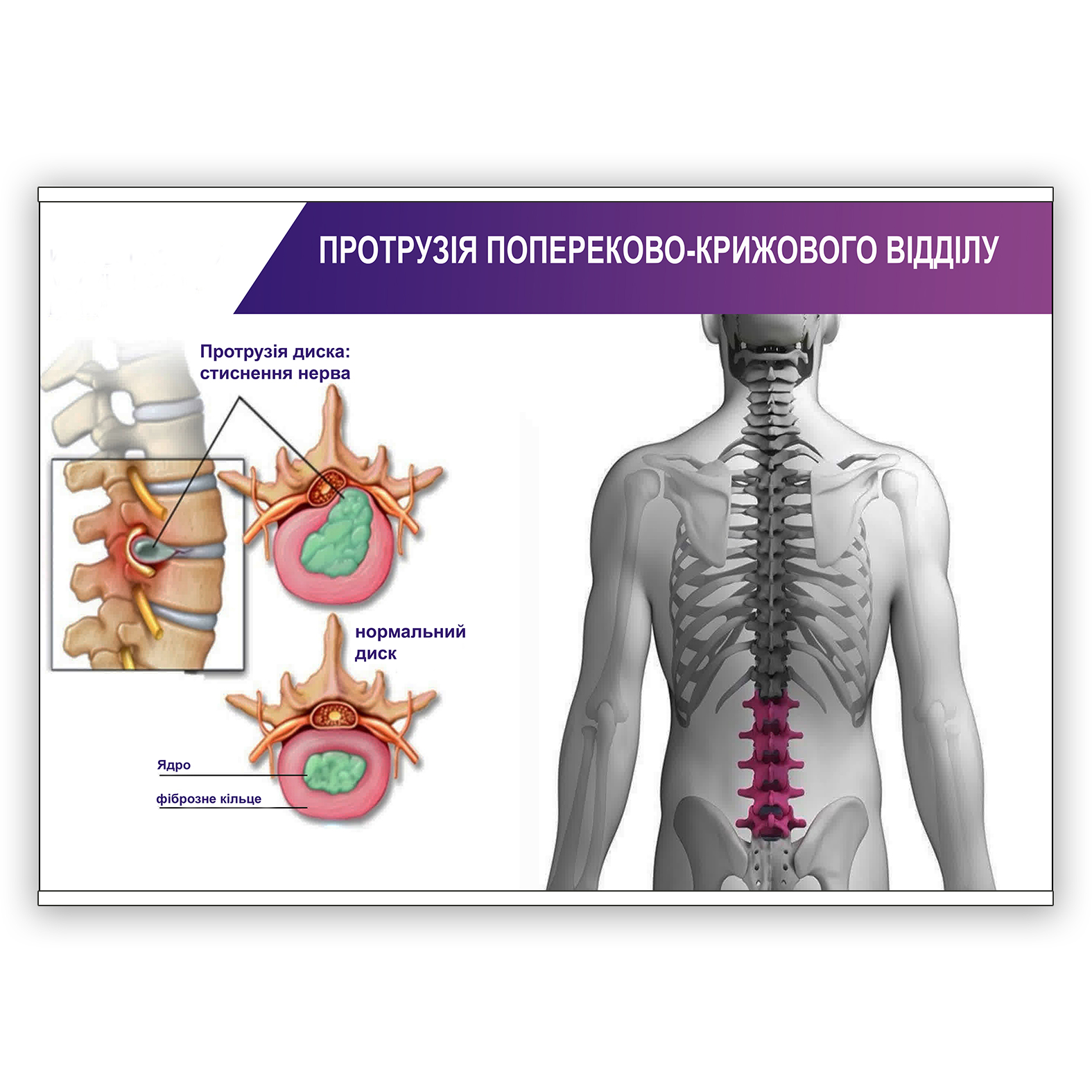 Плакат Vivay “Протрузія попереково-крижового відділу” А3 (8938)