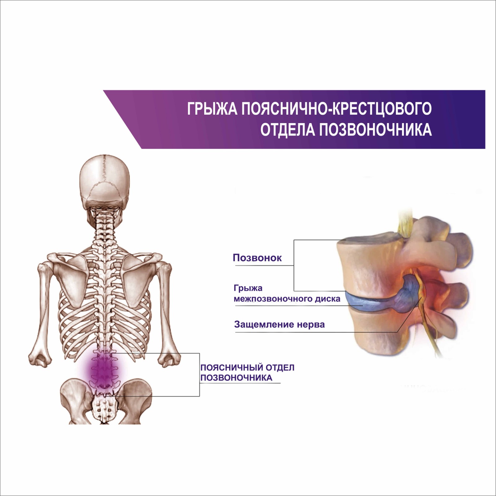 Плакат Грыжа пояснично-крестцового отдела позвоночника А1