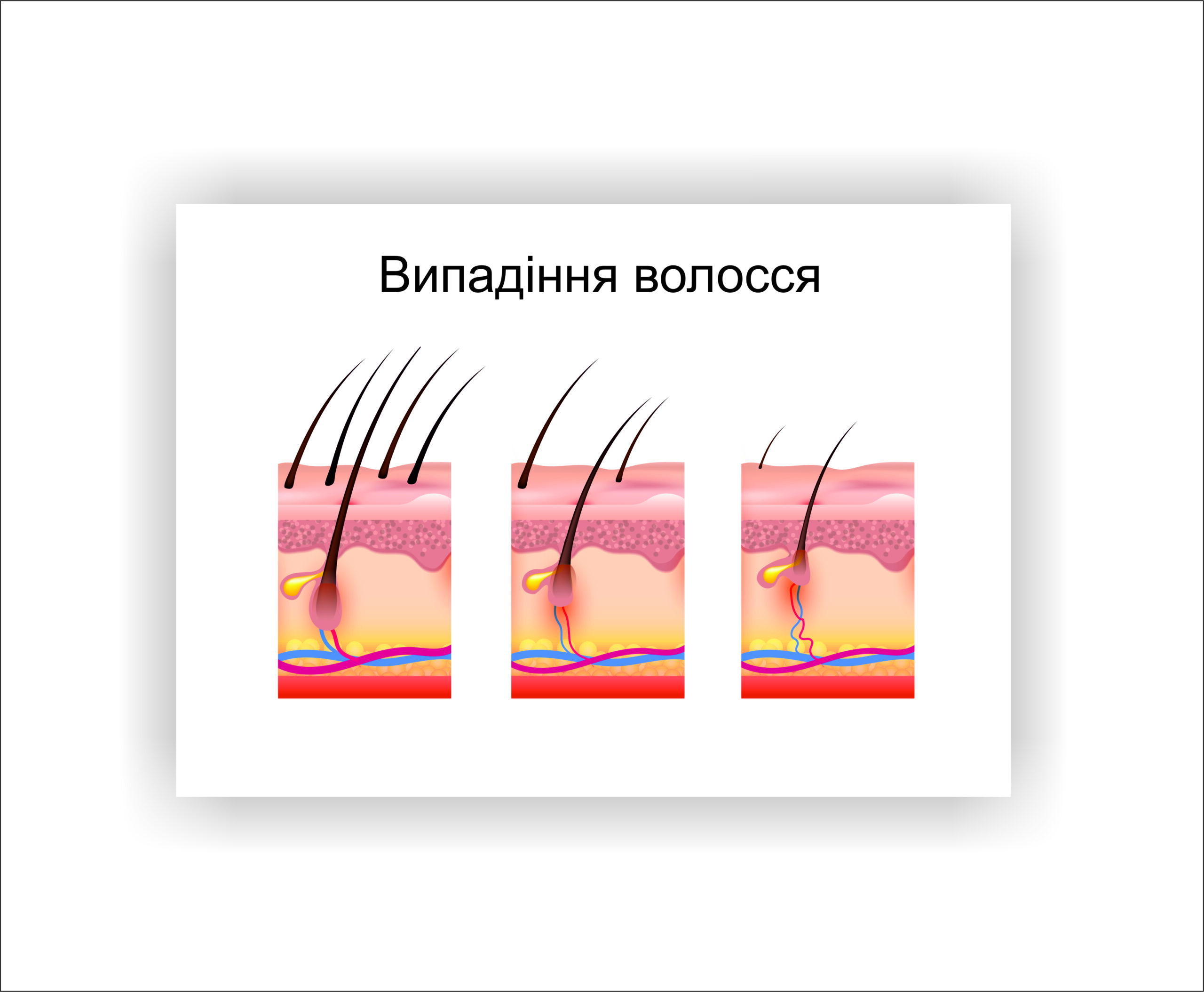 Плакат Vivay Выпадение волос 30х40 см Белый