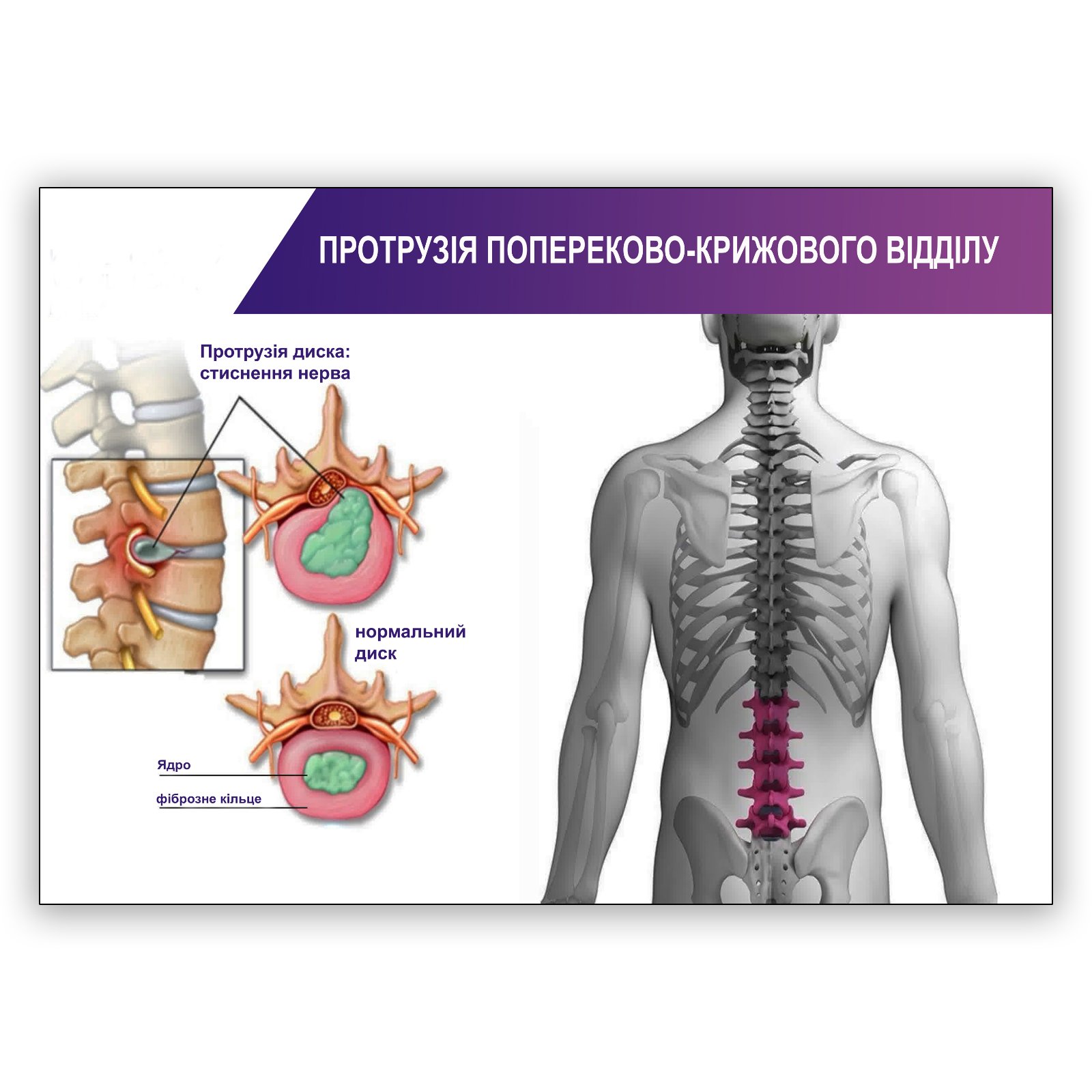 Плакат “Протрузія попереково-крижового відділу” Vivay А2